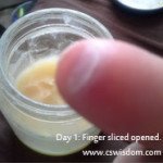 Day 1: Applying ointment to cut finger